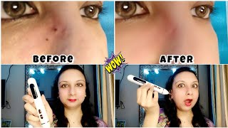 How to remove mole using mole remover pen || best product to make your skin clear #mole #skin #viral