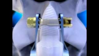 The coflex-F® Rivet | Paradigm Spine | Spine Treatment \u0026 Surgery