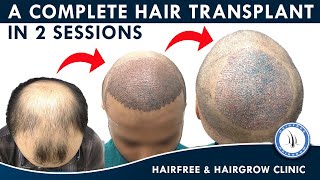 Hair Transplant in 2 Sessions for best Result and Proper Baldness Covered || By Dr. Richa Sanmukhani