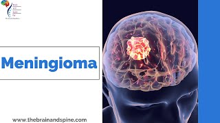 Meningioma: Symptoms, Causes and Treatment| Best Neurosurgeon in Uttar Pradesh| Dr Manish Vaish