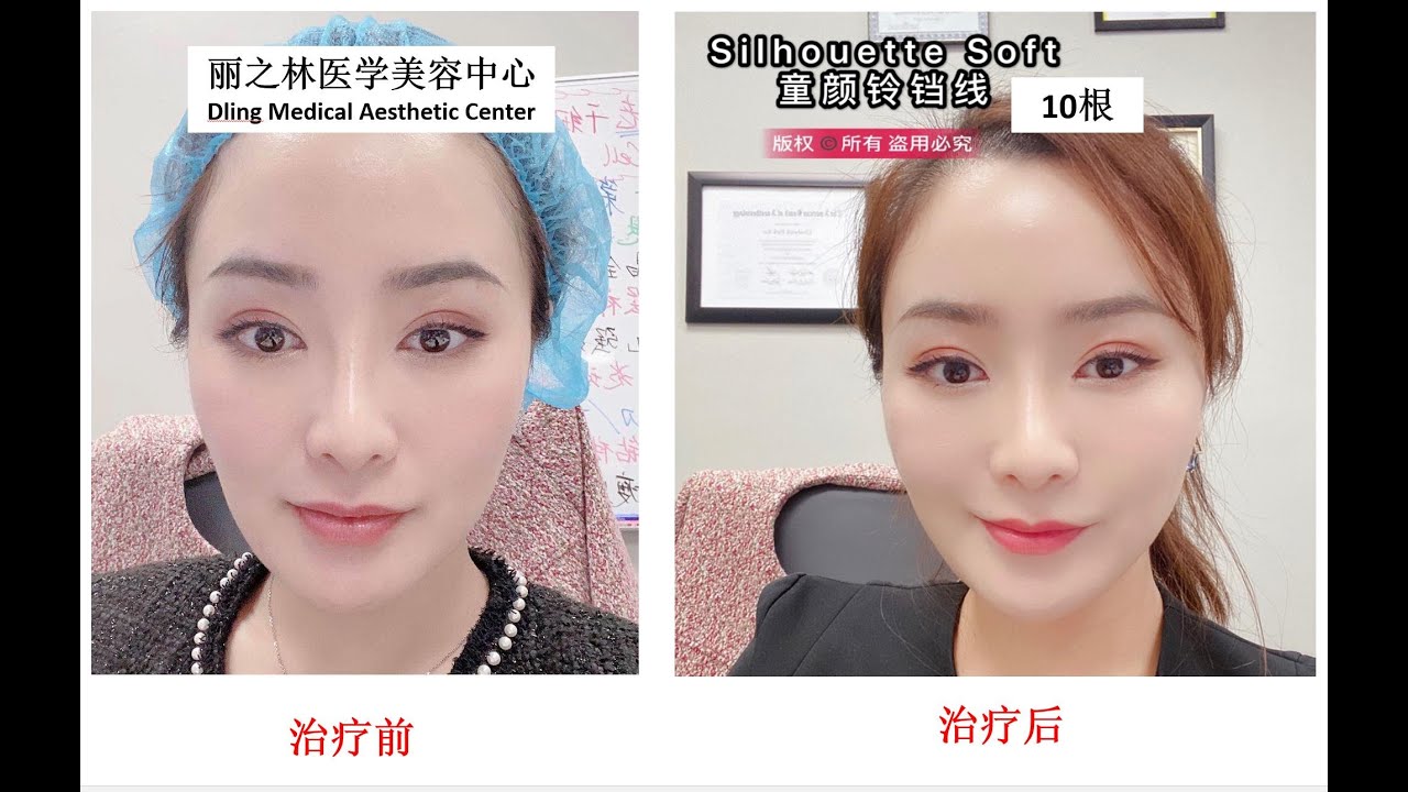 洛杉矶医美】360度”铃铛线”线雕,完美的面部提升! | 丽之林医学美容中心, image size:1280x720