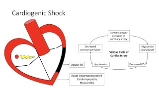 Cardiogenic Shock