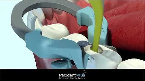 How to Use Palodent Plus Sectional Matrix System Dentbear.com