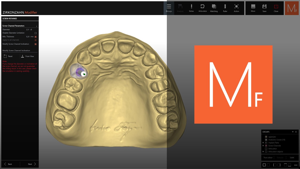 Implant design, fully under control | Zirkonzahn.Modifier