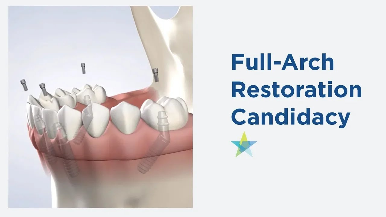 Full-Arch Candidacy in Dallas TX | Park Cities Oral & Maxillofacial Surgery Associates