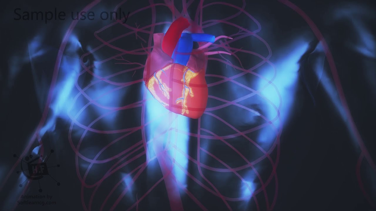 coronary angiogram Micro Needle|3d medical animation|sample use only