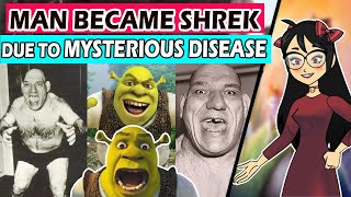 Mysterious Disease Made Man A Shrek Maurice Tillet The French Angel रहसयमय रग Tashreeh