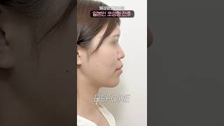 한국까지 와서 성형한 이유? 결과 보면 납득 #별성형외과 #shorts