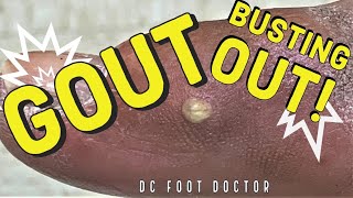 Gout Busting Out!: Gout Crystals Breaking Though The Skin Of The Big Toe