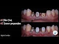 Veneers &amp; Crowns