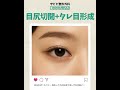 #ザビビ整形外科 👁✨目尻切開＋タレ目形成