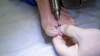 Hammertoe Arthrodesis - DartFire Edge Cannulated Screw System