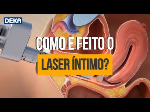 VOU TE MOSTRAR COMO É FEITO O LASER ÍNTIMO