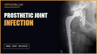 Periprosthetic Joint Infection Masterclass: Diagnosis & Management Framework