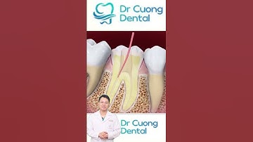 Quá trình điều trị tủy răng |Dr Cường Offical l #bacsicuong #kerangbisau #rangsu