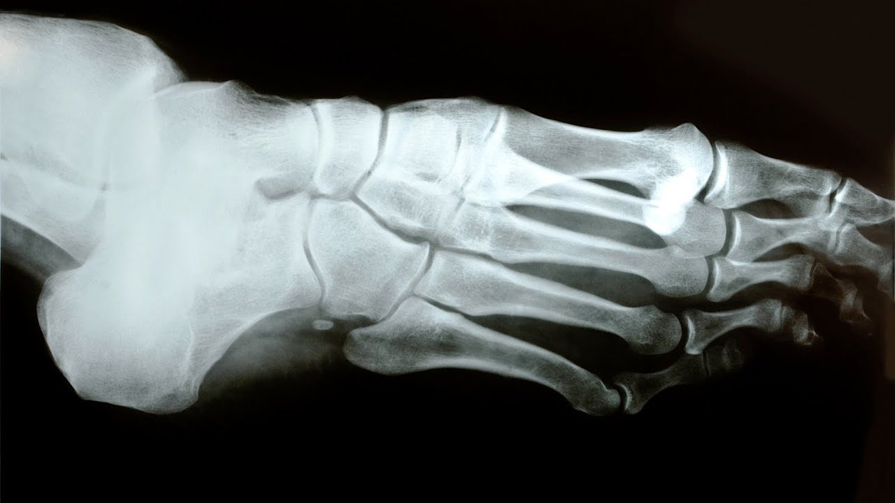 sarok arthrosis deformáló osteoarthritis az 1. fokú kezelés