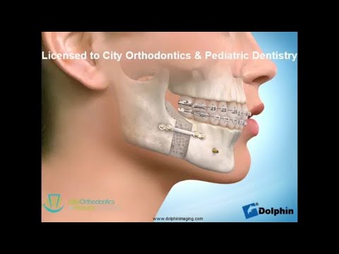 Lower Jaw Surgery | City Orthodontics & Pediatric Dentistry Edmonton