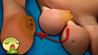 Что под кожей?!😰 Гиперкератоз.Core corn.Deep callus.pedicure