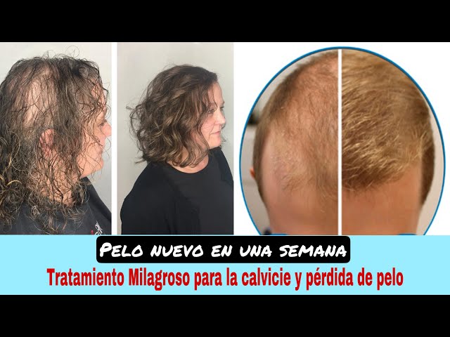 Mejor Tratamiento Contra La Caida Del cabello Natural Aceite Para Crecer  Pelo