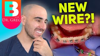 Braces Wire Tightening  Why & How Your Orthodontist Changes Your Braces Wires