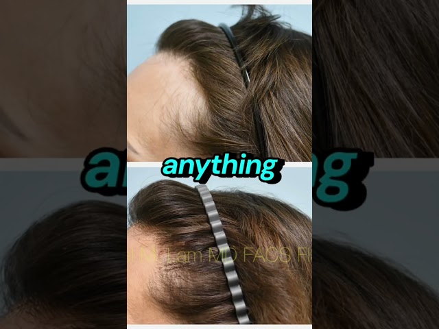 Frontal Fibrosing Alopecia (FFA) Transplant into Hairline & Eyebrows: Results, Interview, Testimony