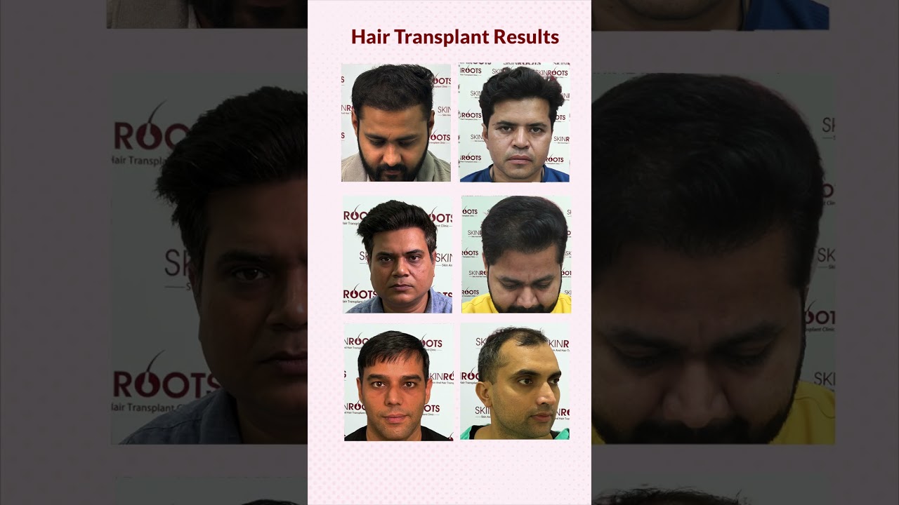 FUE Hair Transplant Results | Natural Hairline & Before After Transformation | Delhi, India