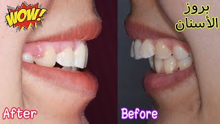 ضب الاسنان | قبل و بعد تقويم بروز الأسنان | تفاصيل هامه Before and After Braces off