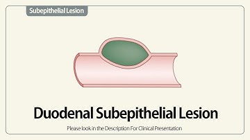 Duodenal Subepithelial Lesion.