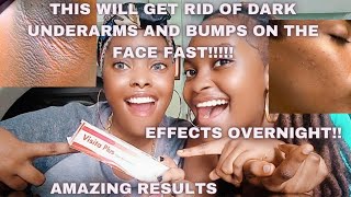 HOW TO GET RID OF BUMPS ON THE FACE FAST!! | Get rid of dark underarms fast| Visita Plus Review