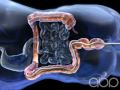 Colonoscopy - 3D Medical Animation || ABP ©