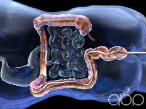 Colonoscopy - 3D Medical Animation || ABP © - YouTube