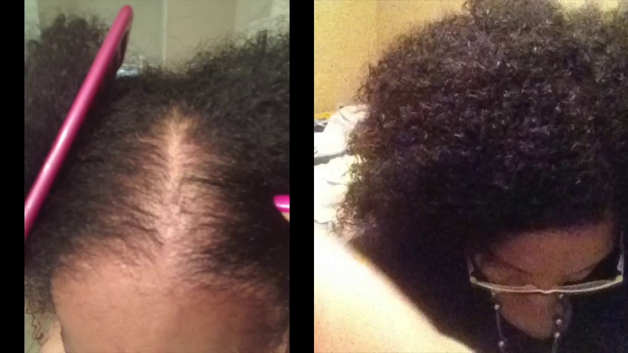 STOP EXCESSIVE HAIR SHEDDING AND THINNING NATURALLY! YouTube