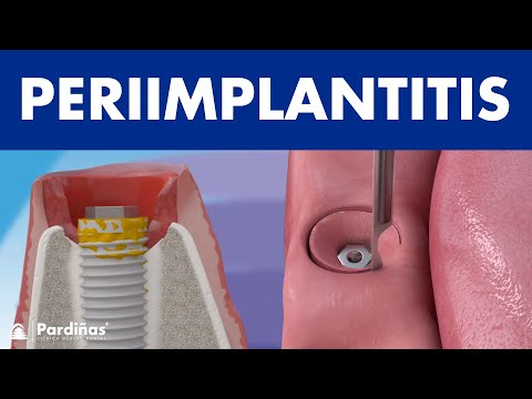 Video: Probleme Mit Frühen Und Späten Zahnimplantaten