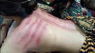 Kerokan masuk angin !!!! #kerokan #masukangin #asmr