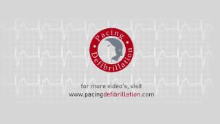 LifeVest | Oversensing 1