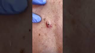 Fascinating blackhead pop shorts | CONTOUR DERMATOLOGY