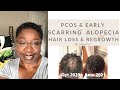 Early scarring alopecia hair loss and regrowth pt 1