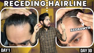 सिर्फ 1 महीने मैं RECEDING HAIRLINE REGROW करो | 30 days HAIRLINE REGROWTH challenge