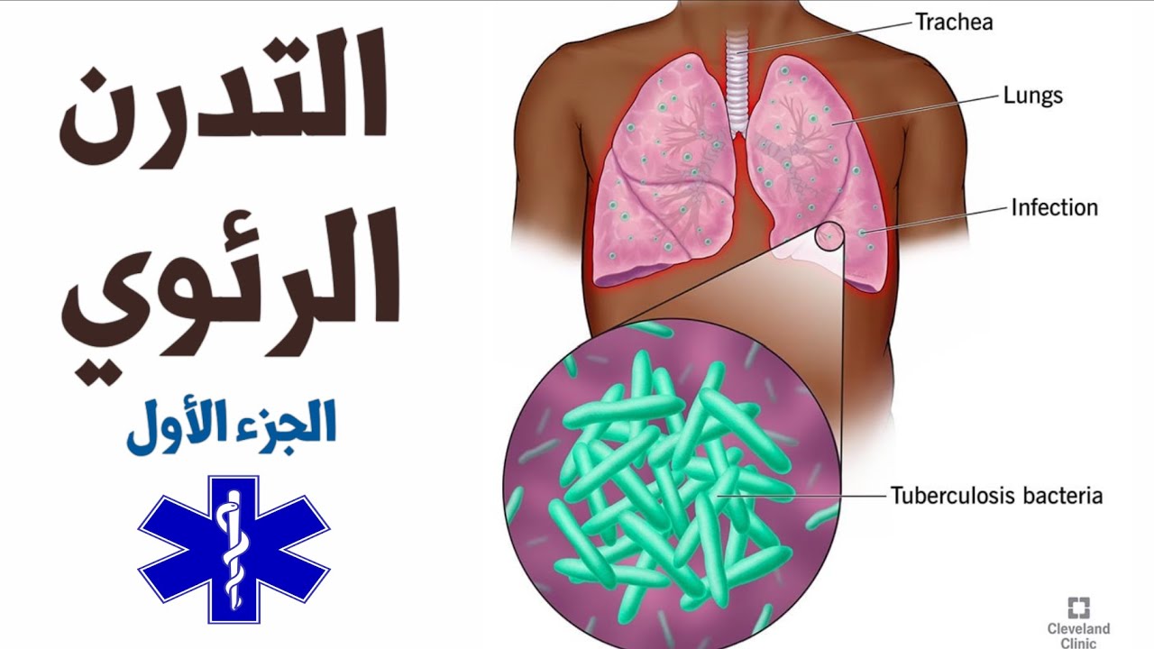 All What You Know About Tuberculosis | كل ما تريد معرفته عن التدرن الرئوي