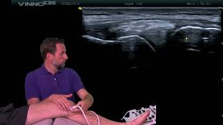 Download Lagu Echografie van de mediale knie - MCL MP3