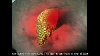 ovarian cancer abdominal mass paraziti u organizmu covjeka