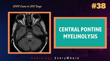 CENTRAL PONTINE MYELINOLYSIS Radiology Tutorials 1000 videos in 100 days video 38