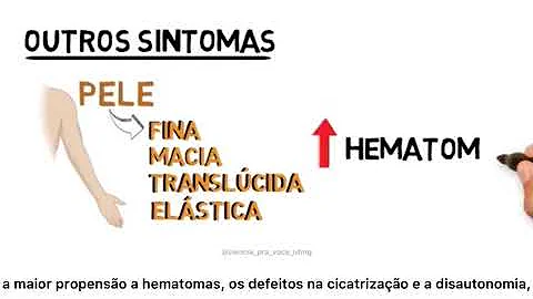 O que é a síndrome de Marfan?