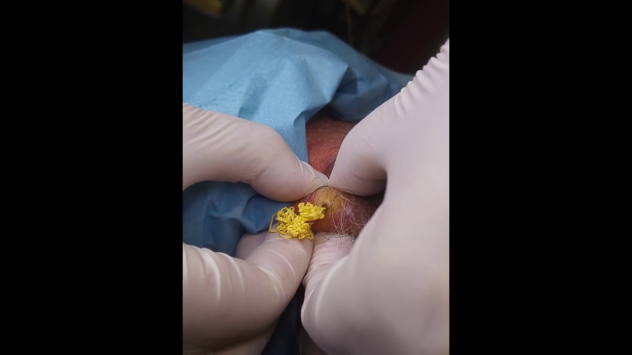 Removal of visible sebaceous cyst on the back