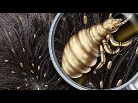 چۆن بزانی ئەسپێ لە سەری خۆت یان منداڵەکەت ھەیە چارەسەری چیە