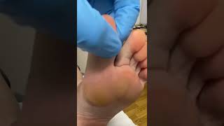 Take A Step Towards Relief! Watch How This Aussie Podiatrist Tackles Big Toe Callus Removal #Feetfir