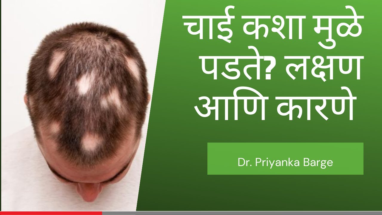 चाई कशा मुळे पडते? चाई लक्षण आणि कारणे उपाय chai padne lakshan karne upay what’s Alopecia areata?