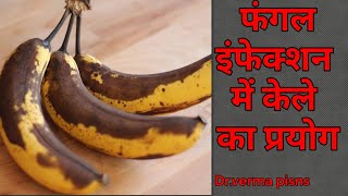 फंगल इंफेक्शन में केले का प्रयोग/Fungal infection #homeramedy #fungalinfection #drvermapisns