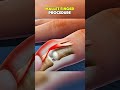 Mallet Finger Procedure|3D ANIMATIONS| #MalletFinger#MalletFingerInjury#MalletFingerTreatment#fyp