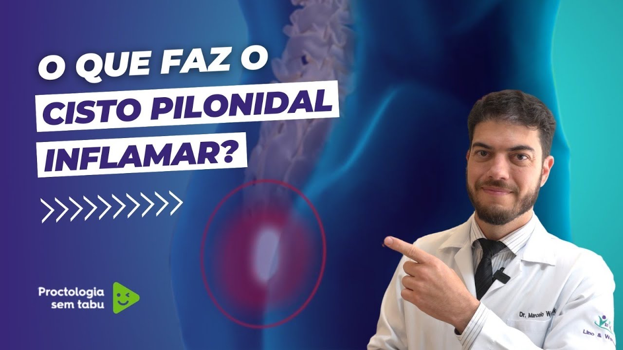 O que faz o cisto pilonidal inflamar? Cisto pilonidal inflamado